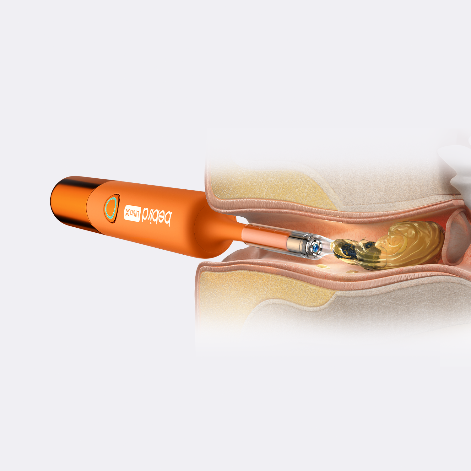 Bebird EarSight Ultra X - Smarte 4K-Ohrpflege